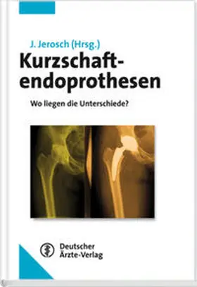 Jerosch |  Kurzschaftendoprothesen | Buch |  Sack Fachmedien