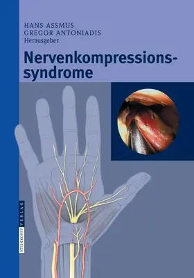 Assmus / Antoniadis |  Nervenkompressionssyndrome | eBook | Sack Fachmedien
