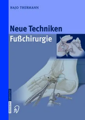 Thermann |  Neue Techniken Fusschirurgie | eBook | Sack Fachmedien