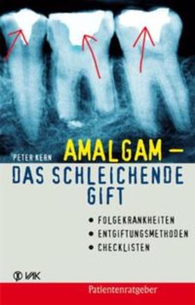 Kern | Amalgam - das schleichende Gift | Buch | 978-3-86731-006-2 | sack.de