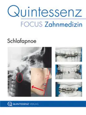 Langenhan / Bußmeier |  Schlafapnoe | Buch |  Sack Fachmedien