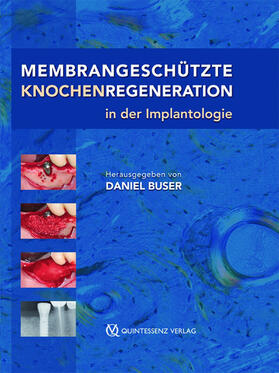 Buser | Membrangeschützte Knochenregeneration in der Implantologie | E-Book | sack.de