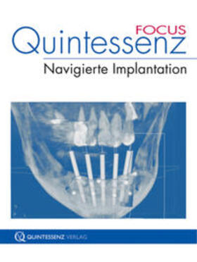 Hopp / Stachulla | Quintessenz FOCUS Navigierte Implantation | Buch | 978-3-86867-040-0 | sack.de