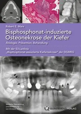 Marx | Bisphosphonat-induzierte Osteonekrose der Kiefer | Buch | 978-3-86867-107-0 | sack.de