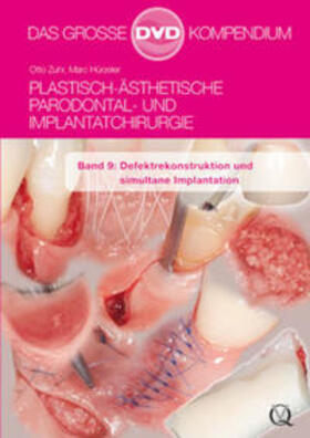 Zuhr / Hürzeler | Plastisch-Ästhetische Parodontal- und Implantatchirurgie | Sonstiges | 978-3-86867-154-4 | sack.de