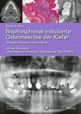 Marx |  Bisphosphonat-induzierte Osteonekrose der Kiefer | eBook | Sack Fachmedien