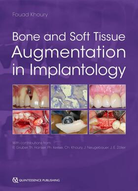 Khoury | Bone and Soft Tissue Augmentation in Implantology | E-Book | sack.de