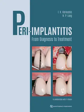 Karoussis / Lang |  Peri-Implantitis | eBook | Sack Fachmedien