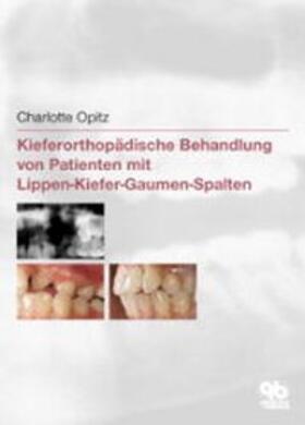 Opitz | Kieferorthopädische Behandlung von Patienten mit Lippen-Kiefer-Gaumen-Spalten | Buch | 978-3-87652-328-6 | sack.de