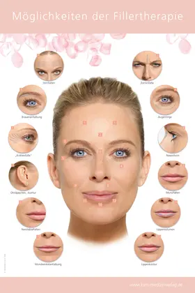  Poster Möglichkeiten der Fillertherapie | Sonstiges |  Sack Fachmedien