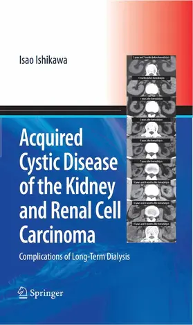 Ishikawa |  Acquired Cystic Disease of the Kidney and Renal Cell Carcinoma | eBook | Sack Fachmedien