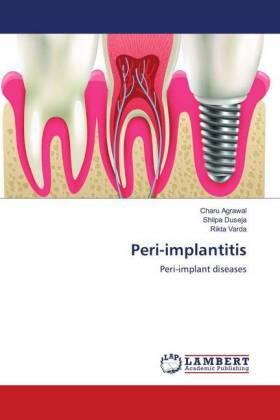 Agrawal / Duseja / Varda |  Peri-implantitis | Buch |  Sack Fachmedien
