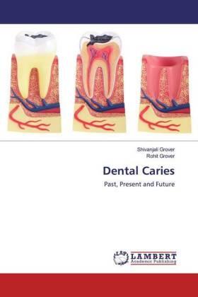 Grover |  Dental Caries | Buch |  Sack Fachmedien