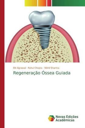 Agrawal / Chopra / Sharma |  Regeneração Óssea Guiada | Buch |  Sack Fachmedien