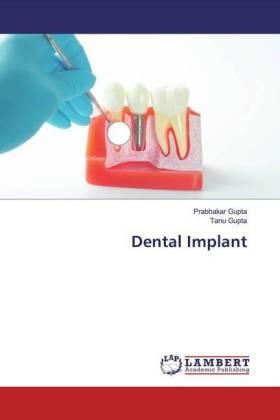 Gupta |  Dental Implant | Buch |  Sack Fachmedien