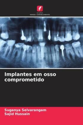 Selvarangam / Hussain |  Implantes em osso comprometido | Buch |  Sack Fachmedien