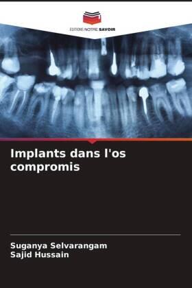 Selvarangam / Hussain |  Implants dans l'os compromis | Buch |  Sack Fachmedien