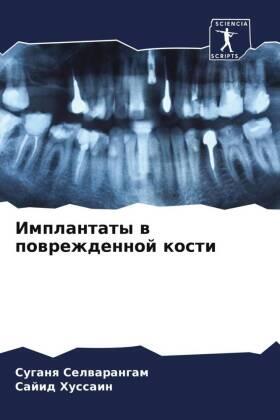 Selwarangam / Hussain |  Implantaty w powrezhdennoj kosti | Buch |  Sack Fachmedien