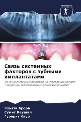 Arora / Kaushal / Kaur |  Swqz' sistemnyh faktorow s zubnymi implantatami | Buch |  Sack Fachmedien