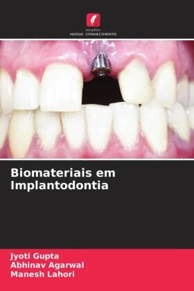 Gupta / Agarwal / Lahori |  Biomateriais em Implantodontia | Buch |  Sack Fachmedien