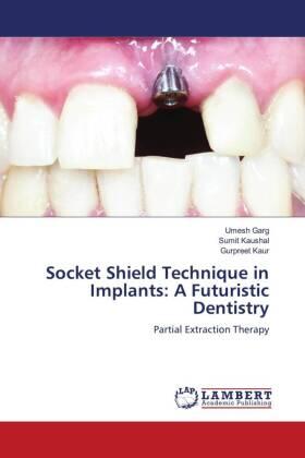 Garg / Kaushal / Kaur | Socket Shield Technique in Implants: A Futuristic Dentistry | Buch | 978-620-5-49172-0 | www.sack.de