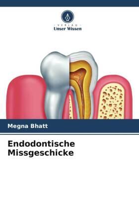 Bhatt |  Endodontische Missgeschicke | Buch |  Sack Fachmedien