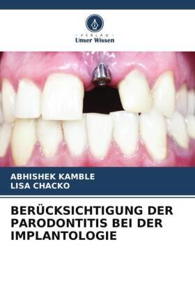 Kamble / Chacko |  BERÜCKSICHTIGUNG DER PARODONTITIS BEI DER IMPLANTOLOGIE | Buch |  Sack Fachmedien