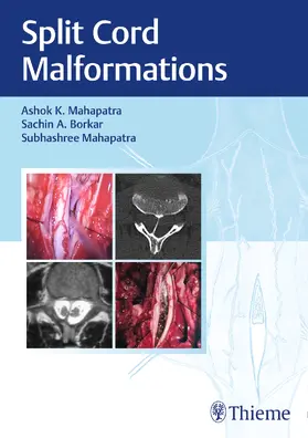 Mahapatra / Borkar | Split Cord Malformations | Buch | 978-81-948570-9-9 | sack.de