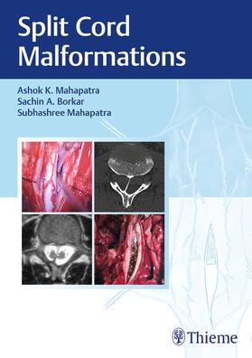 Mahapatra / Borkar | Split Cord Malformations | Buch | sack.de
