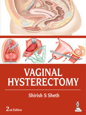 Sheth |  Vaginal Hysterectomy | Buch |  Sack Fachmedien