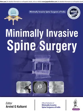 Kulkarni |  Minimally Invasive Spine Surgery | Buch |  Sack Fachmedien