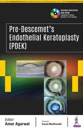Agarwal |  Pre-Descemet’s Endothelial Keratoplasty (PDEK) | Buch |  Sack Fachmedien