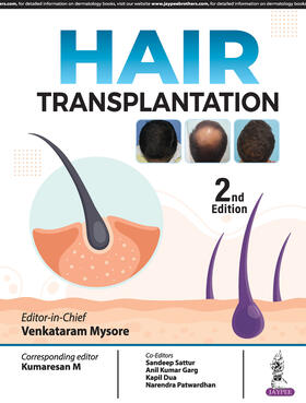 Mysore | Hair Transplantation | Buch | 978-93-5696-441-9 | sack.de