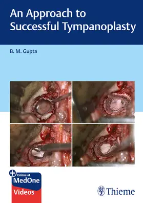 Gupta | An Approach to Successful Tympanoplasty | E-Book | www.sack.de